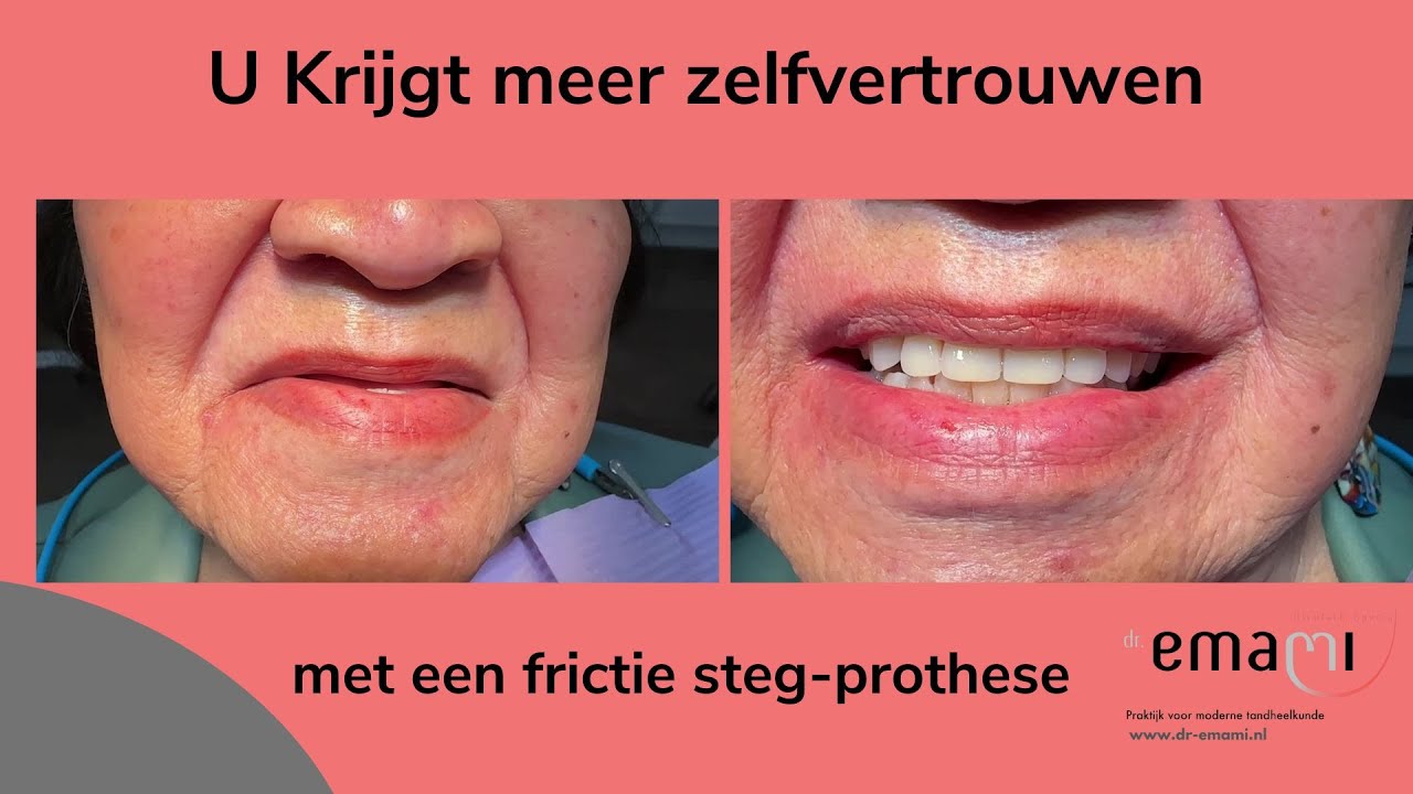 frictie stegprothese, gehemelte vrije kunstgebit, steg, klikgebit