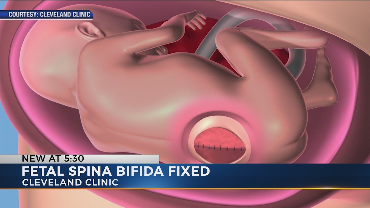 Cleveland Clinic performs its first in utero surgery on fetus, repairs spina bifida before baby’s bi