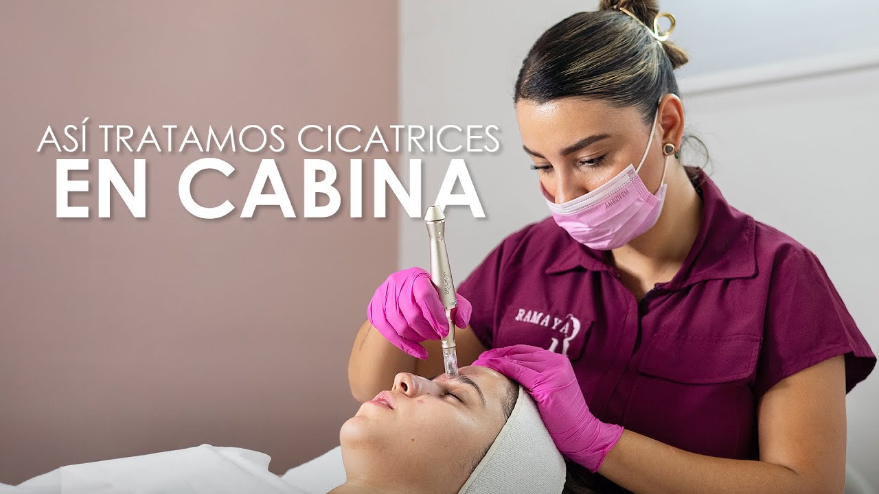 RAGDNET BIOINGENIERIA + MICRONEEDLING PARA CICATRICES POST ACNÉ 🧪 | XIMENA RAMAYA