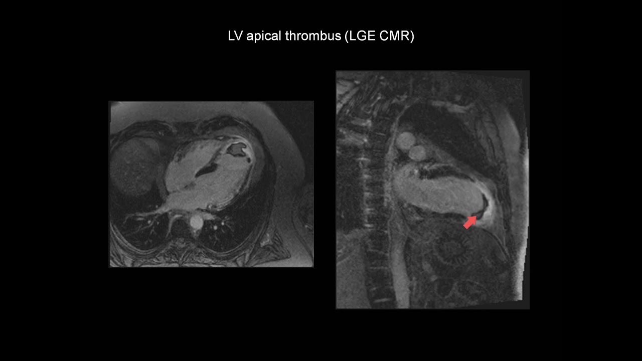 How to assess a left ventricular thrombus with the help of cardiac MRI (CMR)