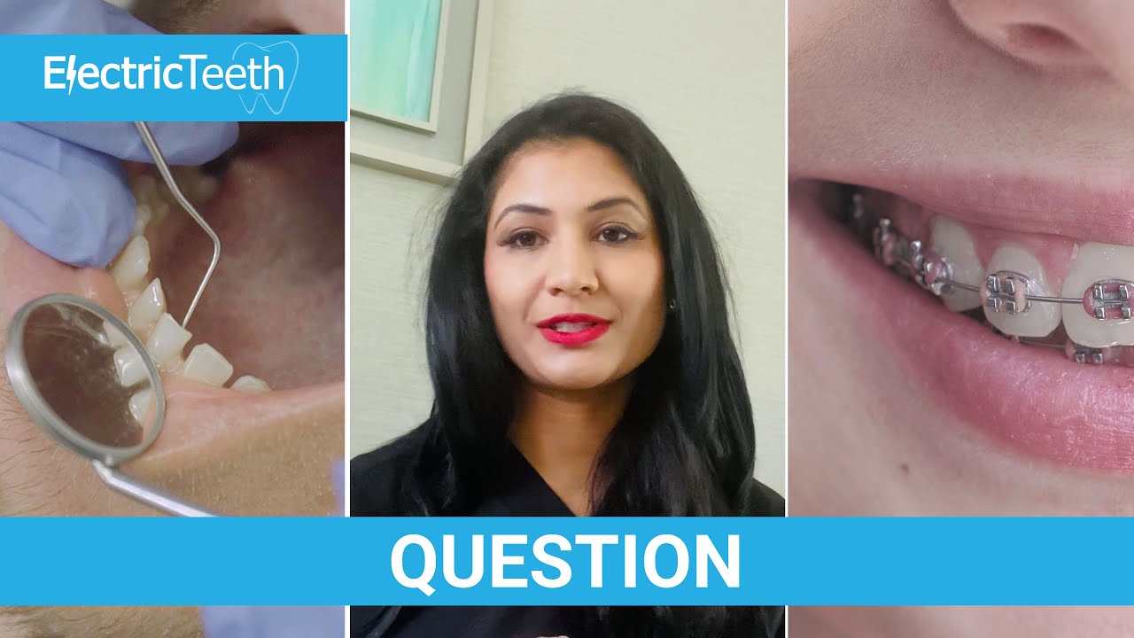 How to close gaps between teeth?