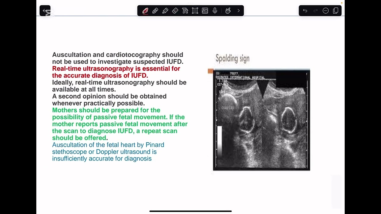 Gyne: IUFD