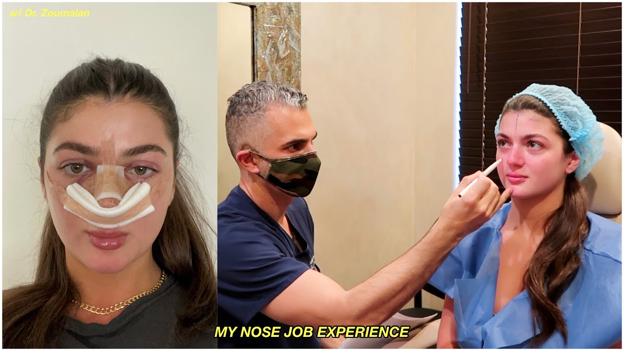 I FLEW ACROSS THE U.S TO GET A NOSE JOB... my experience *part 1*