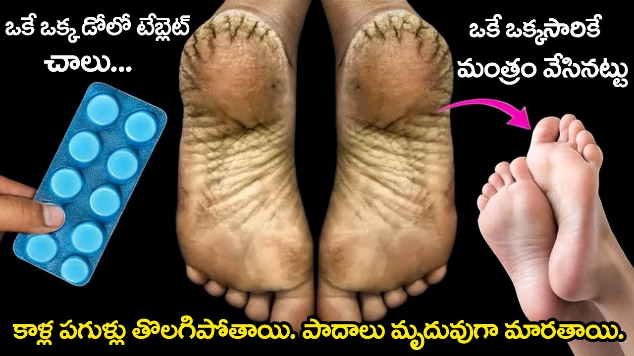 “గ్యారంటీగా! ఒక్క రాత్రిలోనే పగుళ్లైన మడమలు పూర్తిగా నయమవుతాయి👌ఈ మ్యాజిక్ తో మడమలు సాఫ్ట్ అవుతాయి👍