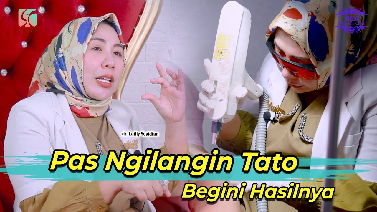 Menghapus Tato dengan Laser Sampai Bersih