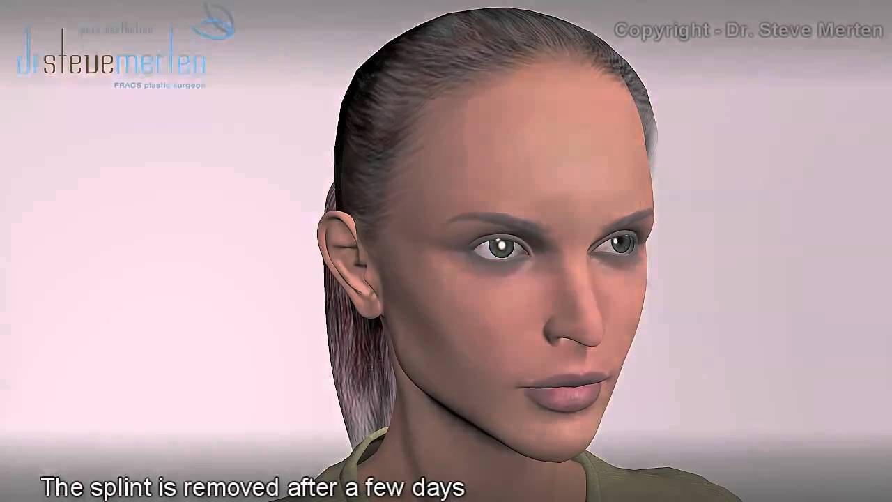 Nasenkorrektur Nasenoperation Animation Dr. Steve Merten in Sydney, Australien