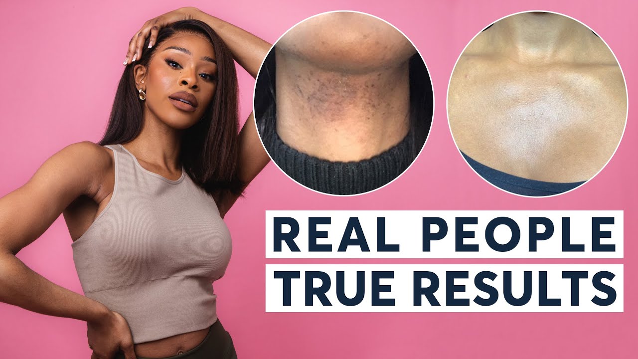 Laser Hair Removal | Real People, True Results