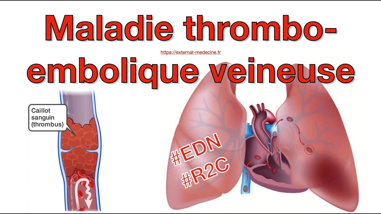 Thrombose veineuse profonde et embolie pulmonaire (item 226) : l'essentiel à retenir pour l'EDN