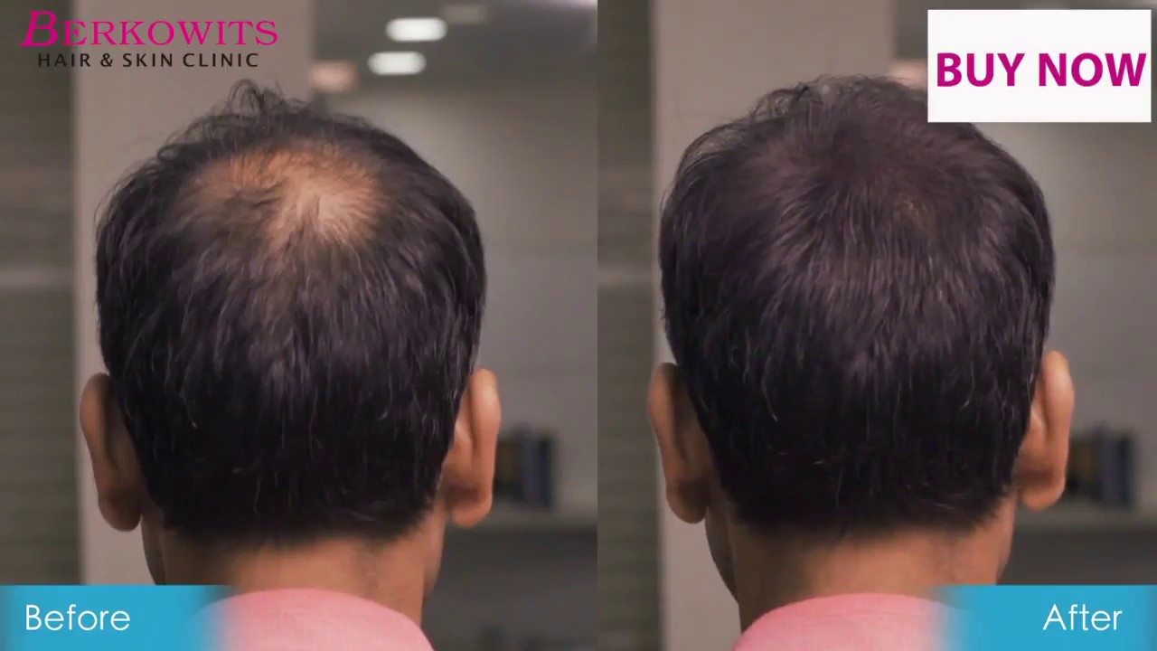 Berkowits Hair Thickening Fibers - Get thick hair after usage immediately. 🌟🌟🌟🌟🌟