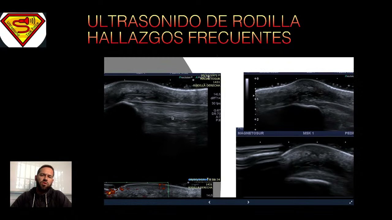 Hallazgos ecográficos en patología de Rodilla.