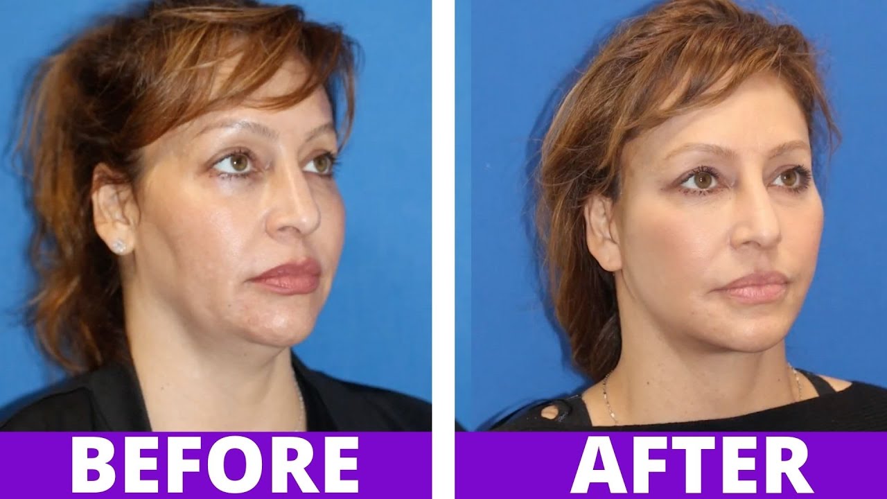 INCREDIBLE Facial Transformation on Woman in 50s (Before and after Vertical Restore Facelift)