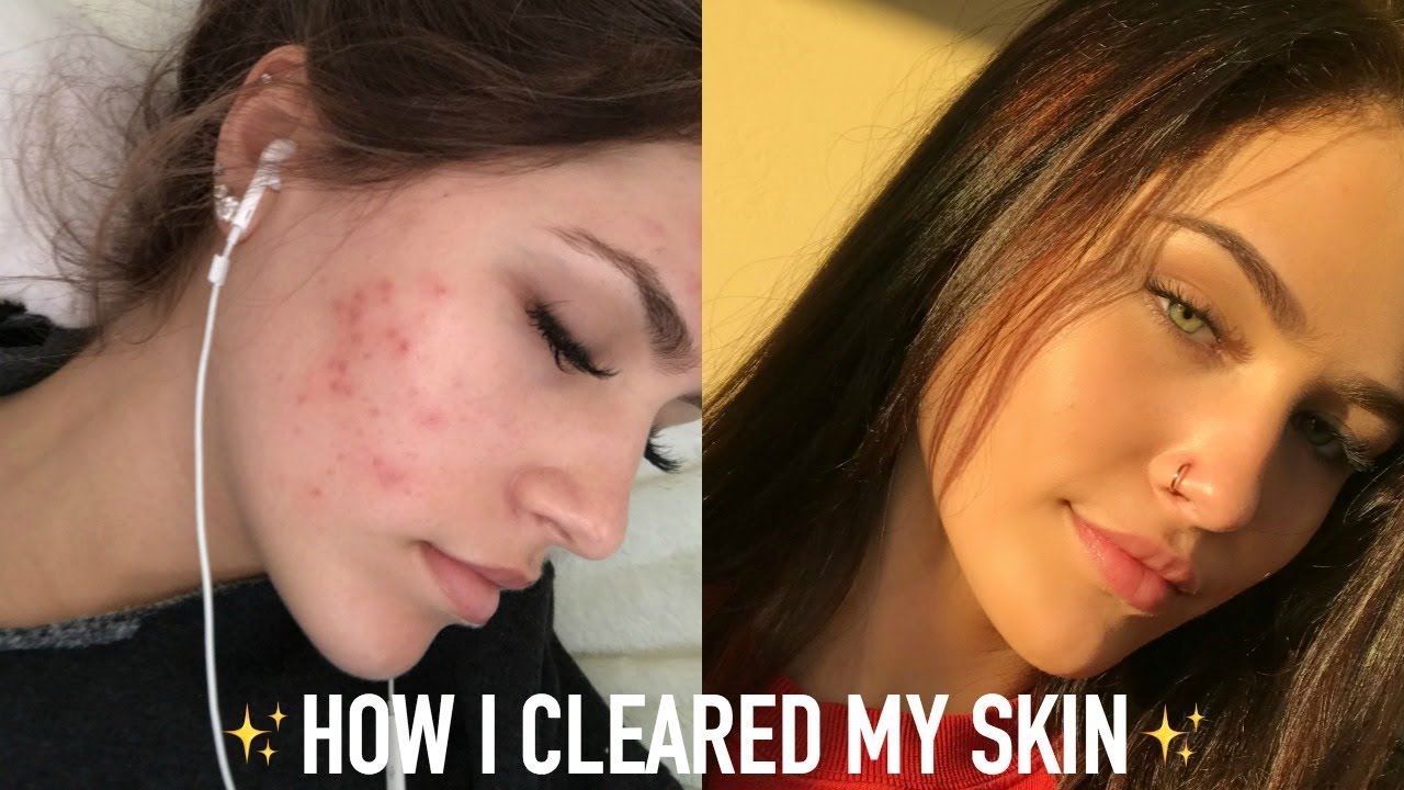 MY SKINCARE ROUTINE! (HOW I CLEARED MY ACNE) | Mel Joy