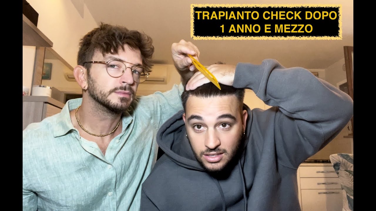 TRAPIANTO CAPELLI TURCHIA - HAIR CHECK DOPO UN ANNO E MEZZO