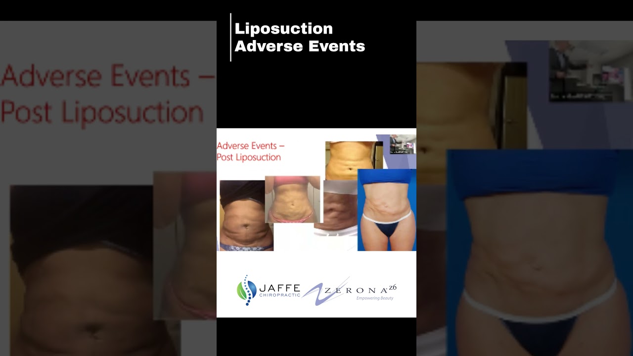 Horrible Side Effects Of Liposuctions!