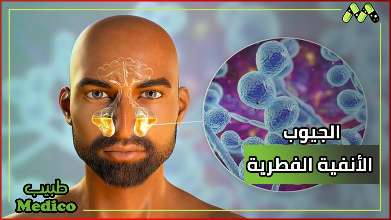 أعراض وأسباب التهاب الجيوب الأنفية الفطيرية وطرق العلاج مع أ.د. أحمد عبد الفتاح