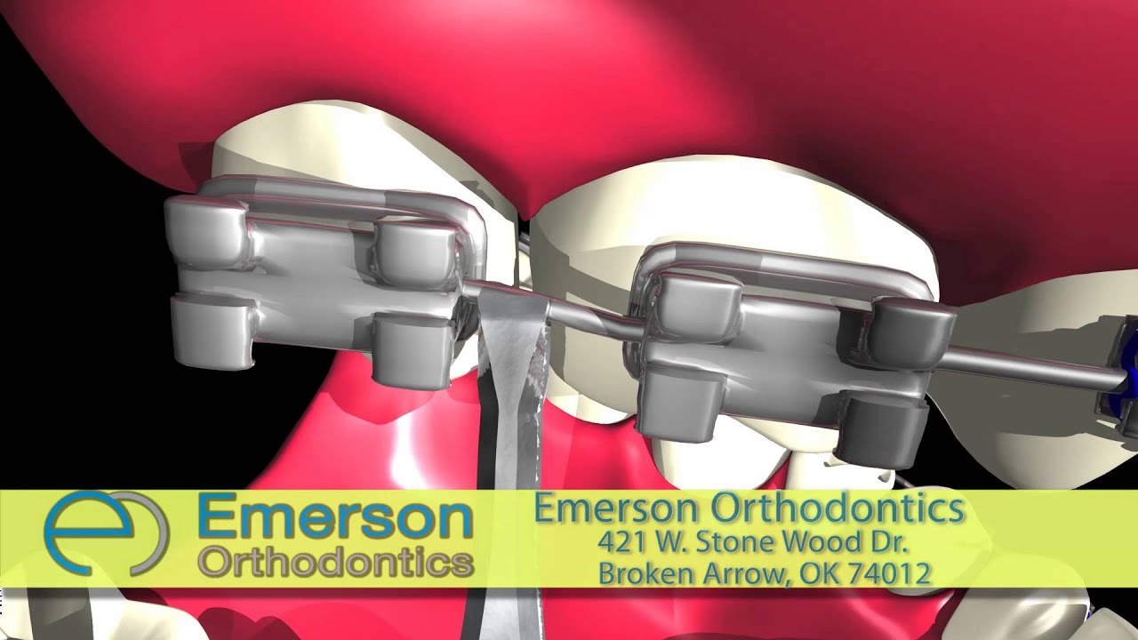 Caring for Loose Braces with Brace Care Videos