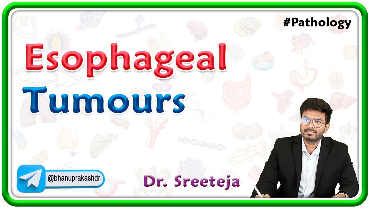 7. Esophageal Tumours ( Benign and Malignant ) :USMLE Step 1 Pathology