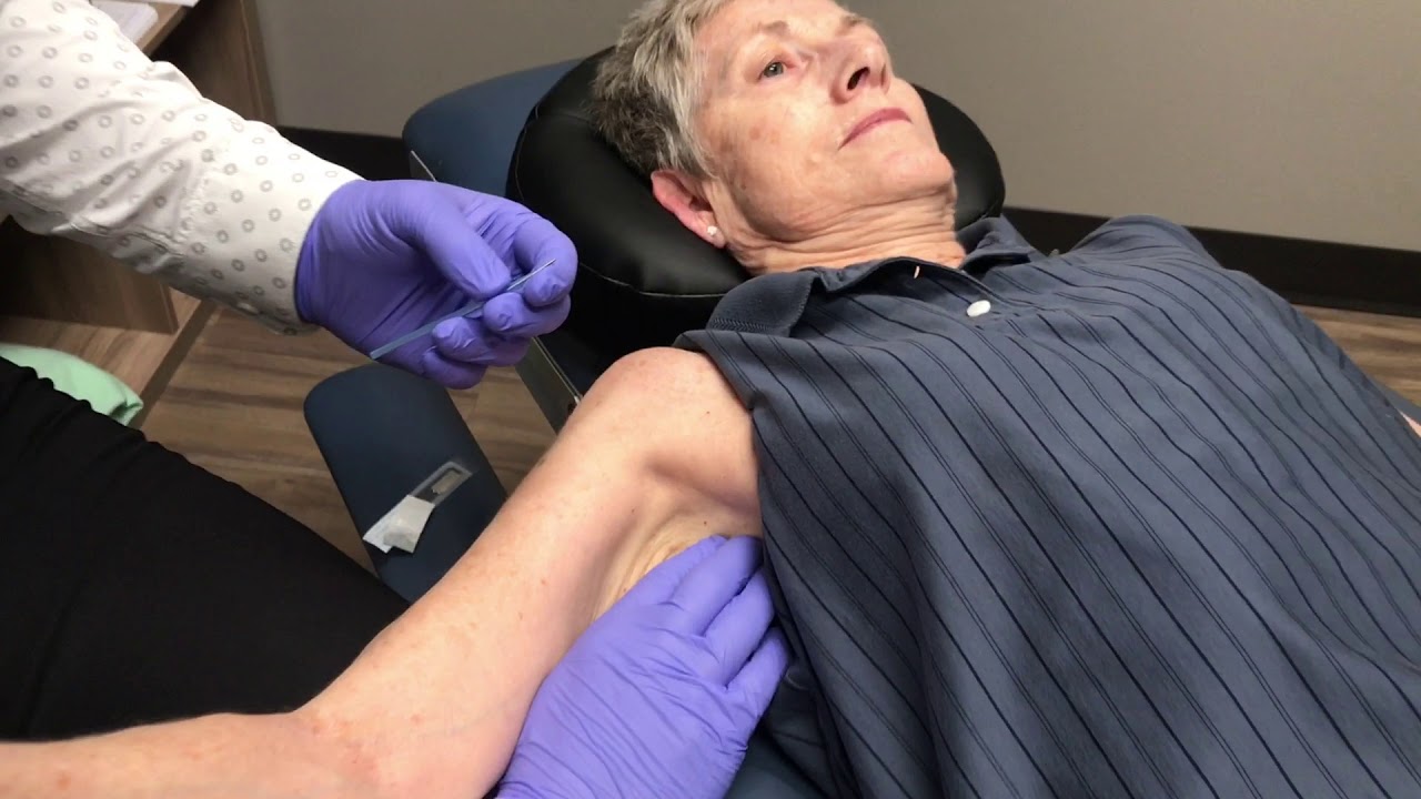 Treating Frozen Shoulder With Dry Needling