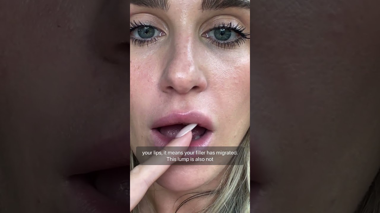 Lip filler storytime