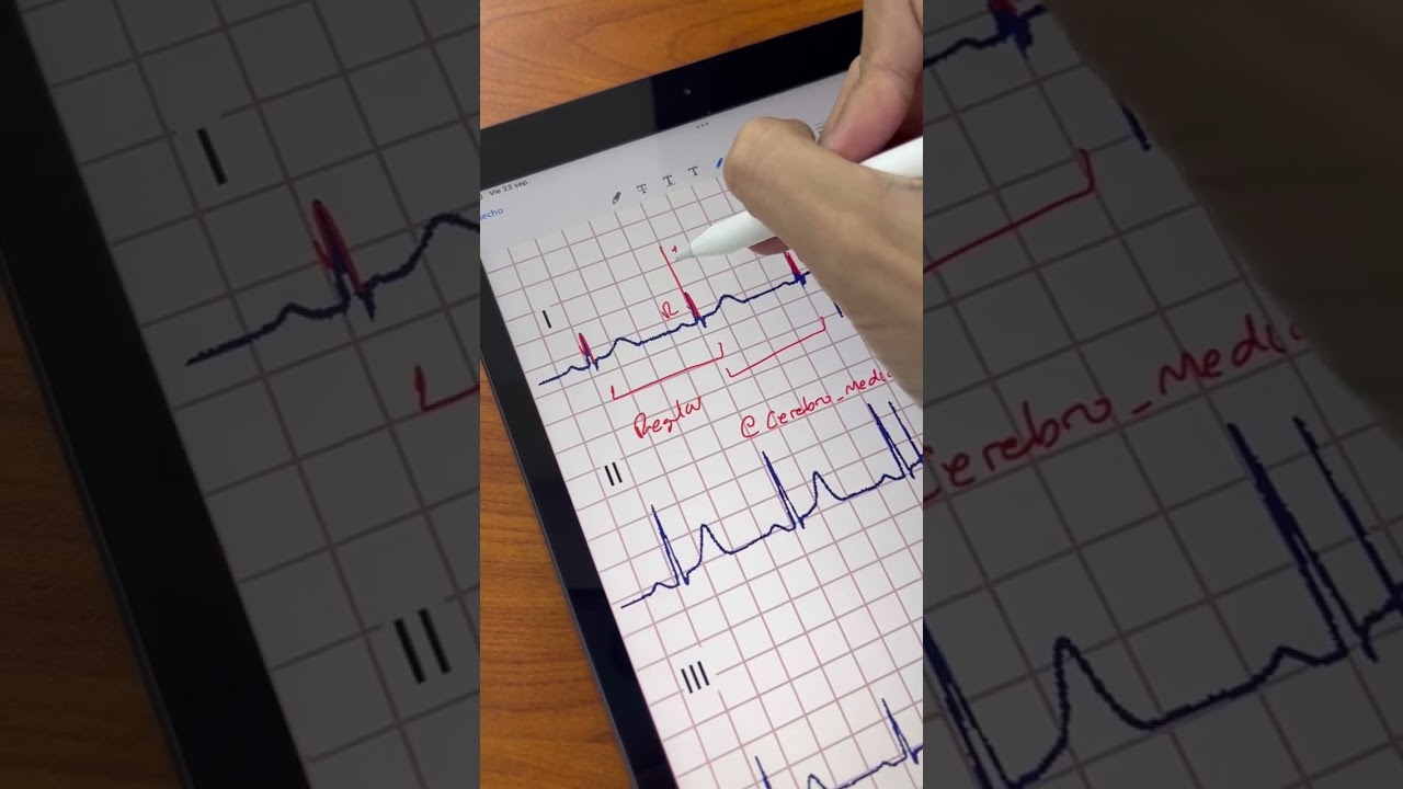 C&oacute;mo calcular la FC en un ECG f&aacute;cil y r&aacute;pido 🤩