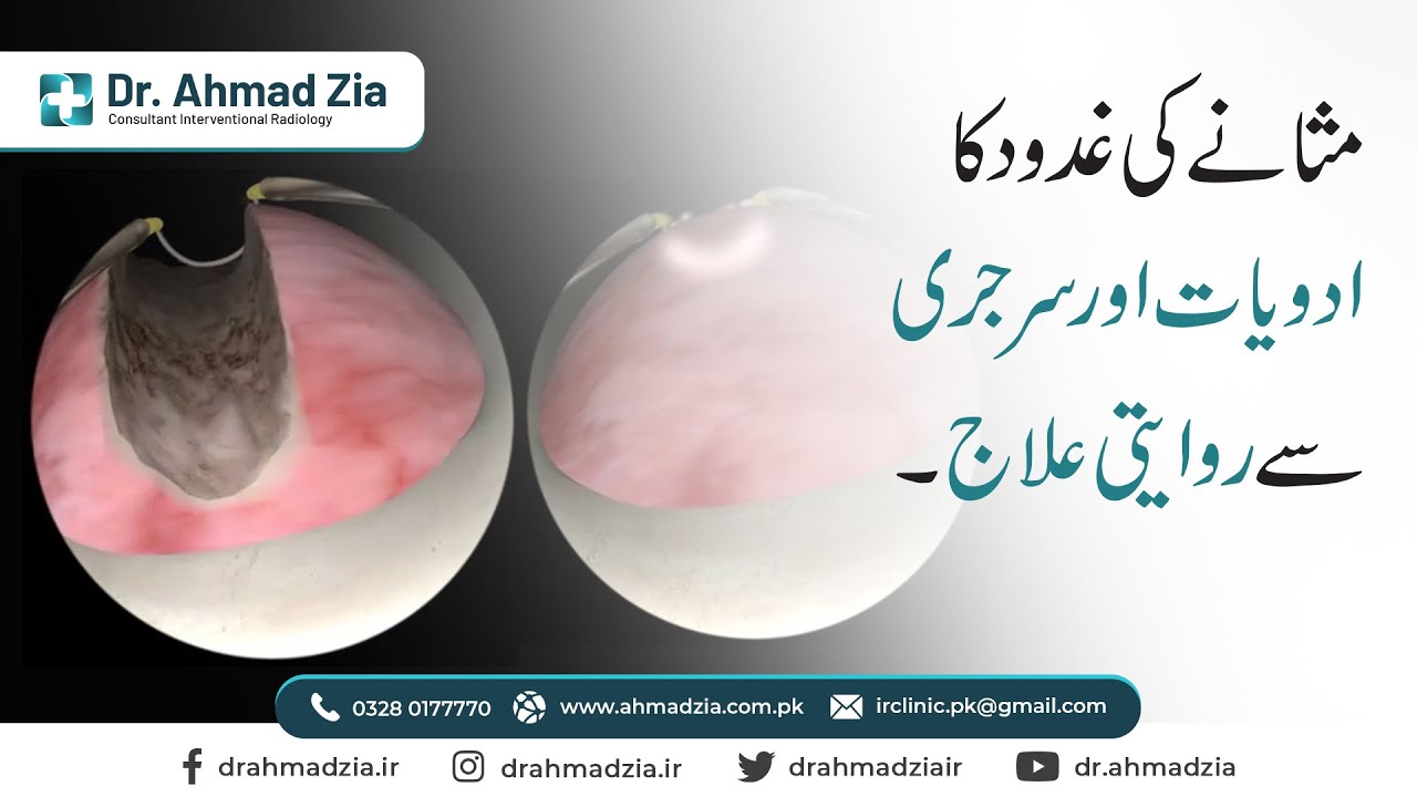 Traditional Treatment of Prostate Gland By Medicine and Surgery | Dr. Ahmad Zia IR Consultant