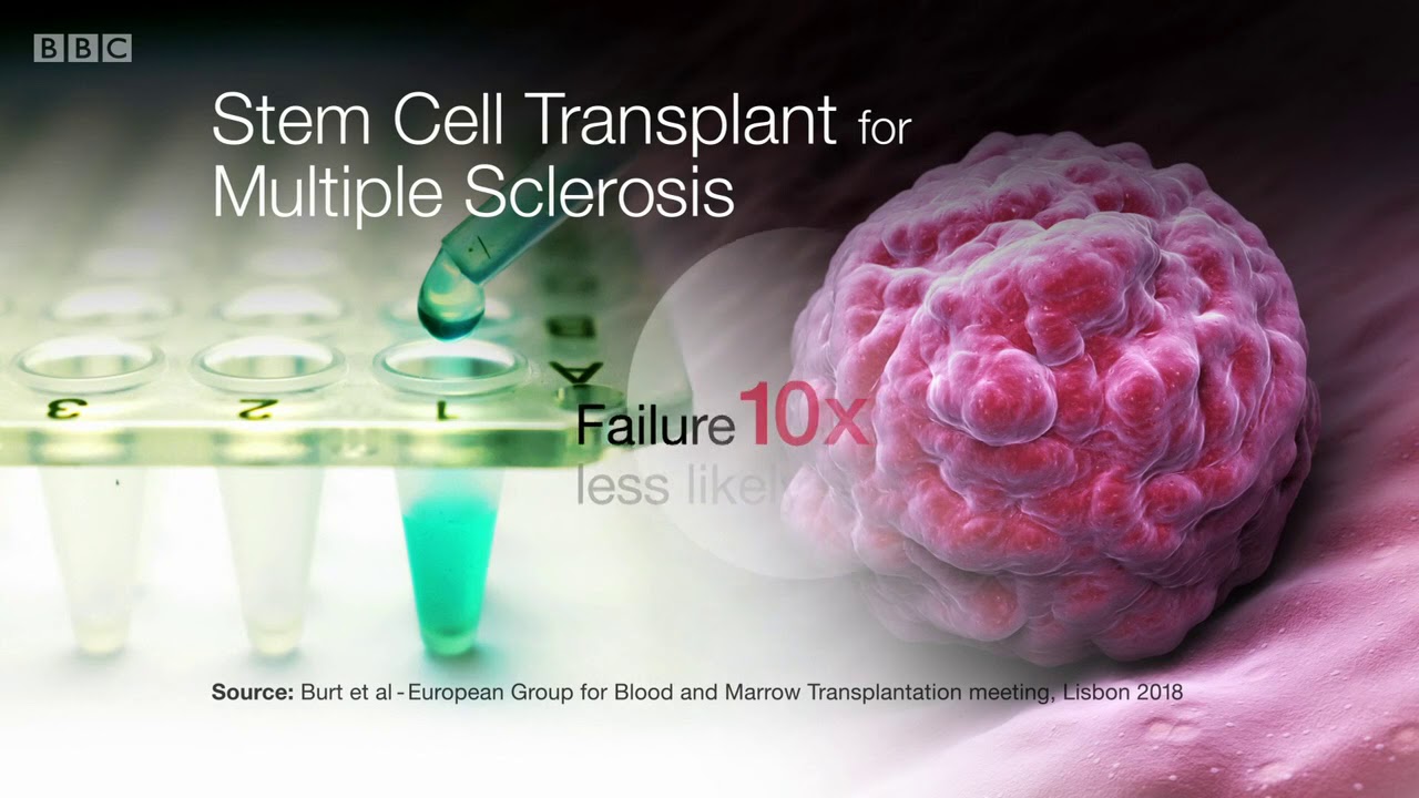 HSCT Stem Cell Transplant for Multiple Sclerosis