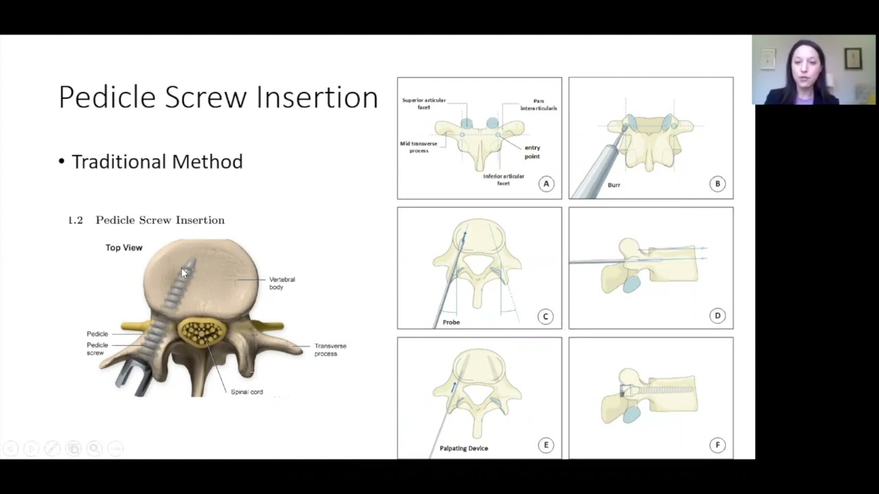 Navigation, Robotics and Augmented Reality in Spine Surgery – Eve Hoffman, M.D.
