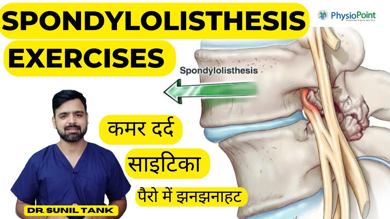 Spondylolisthesis Exercises | Spondylolisthesis physiotherapy treatment  | L4-L5 -L5-S1 | Sciatica