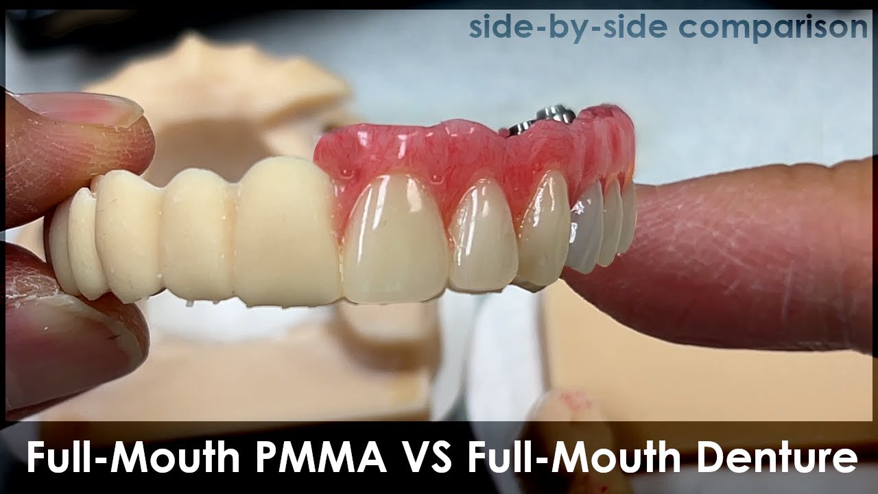 Full-Mouth Implant: PMMA VS Denture Concept | Side-By-Side Comparison