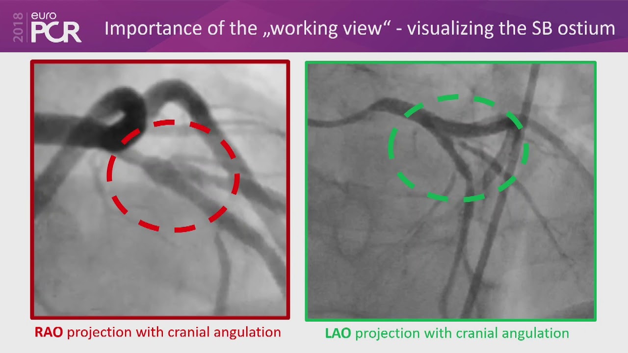 bifurcation lesions most important part2.