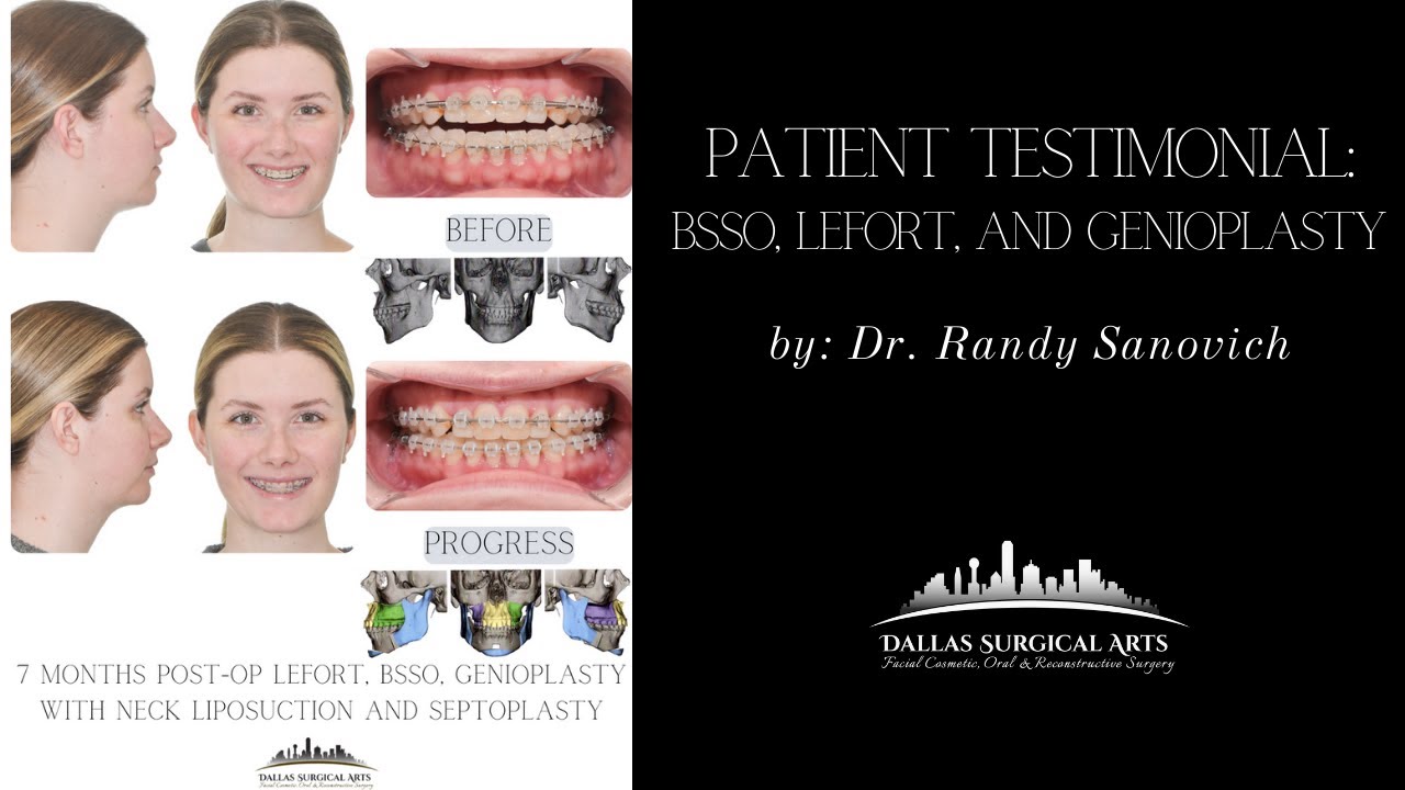 Patient Testimonial: BSSO, LEFORT, and Genioplasty by: Dr. Randy Sanovich