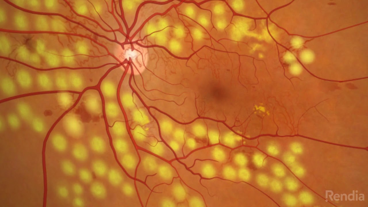 Diabetic Retinopathy  Panretinal Photocoagulation