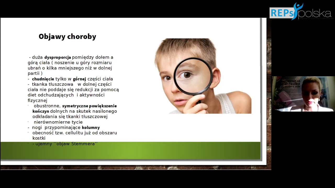 Figura gruszki czy obrzęk tłuszczowy lipoedema? -Beata Bryś