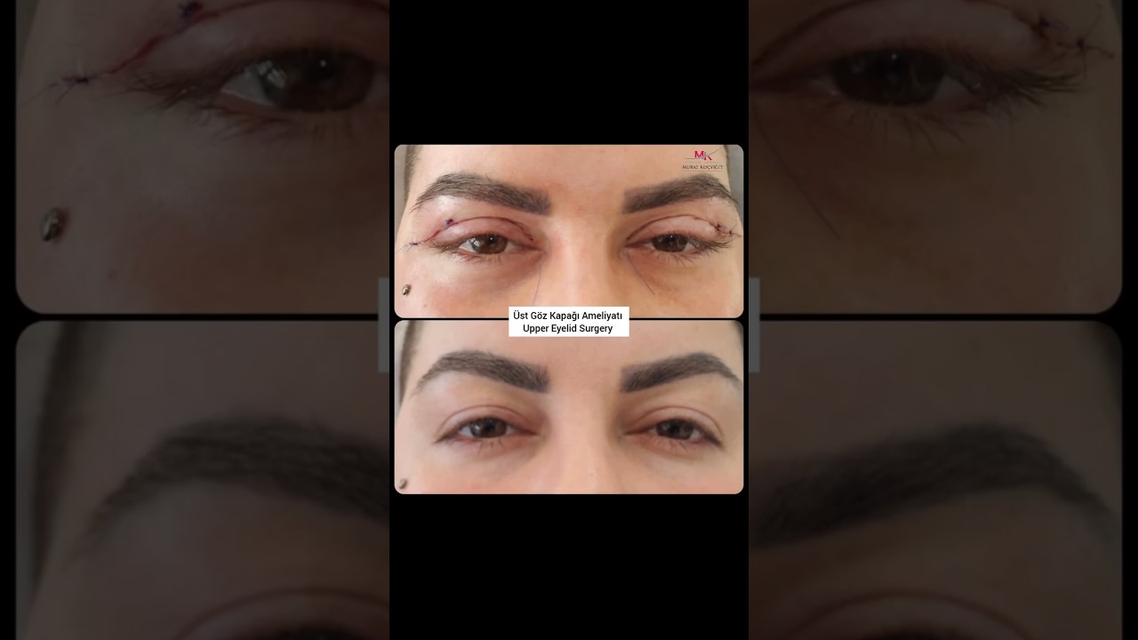 Üst Göz Kapağı Ameliyatı, Upper Eyelid Surgery