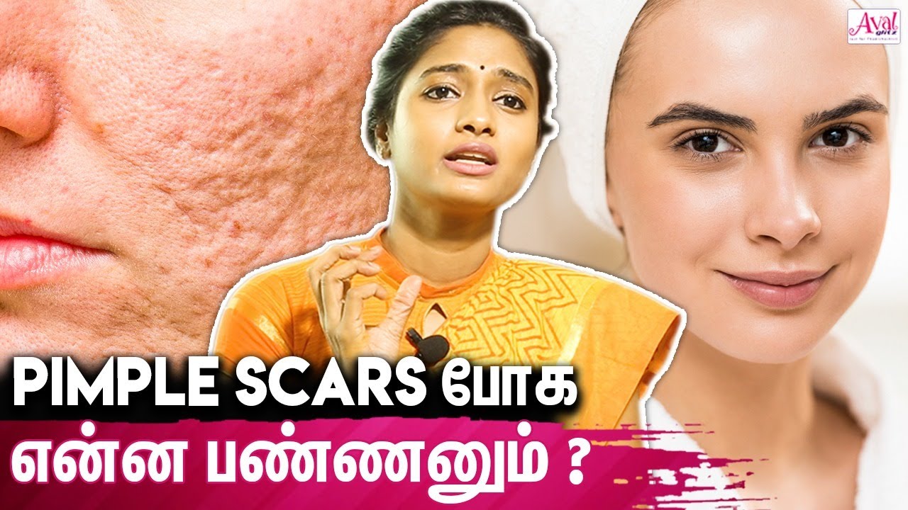 90 % Pimples Scar's ஆக மாற வாய்ப்பு இருக்கு - Skin Specialist Dr Archana | Acne Treatment ,Skin Care