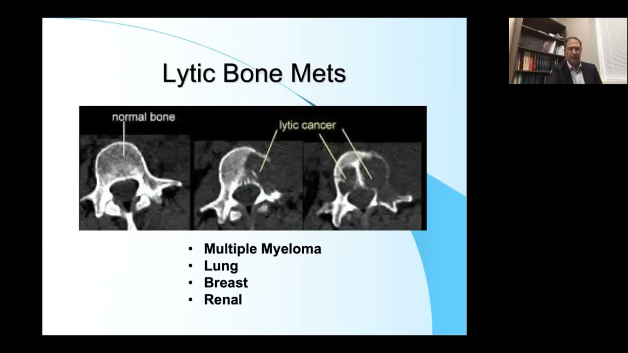Metastatic Bone Disease  Current Treatment Options