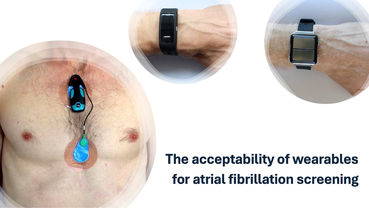 Acceptability of wearables for atrial fibrillation screening: SAFER Wearables Study Interim Analysis
