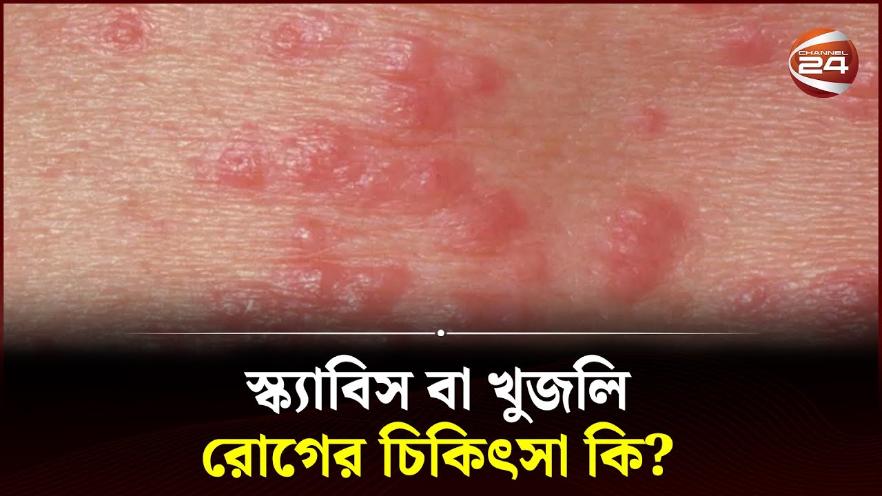 স্ক্যাবিস বা খুজলি রোগের চিকিৎসা কি? | Scabies Treatment | Skin Care | Channel 24