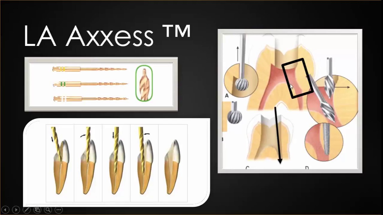 Cirurgia de Acesso ao tratamento Endodôntico - TRATAMENTO DE CANAL.