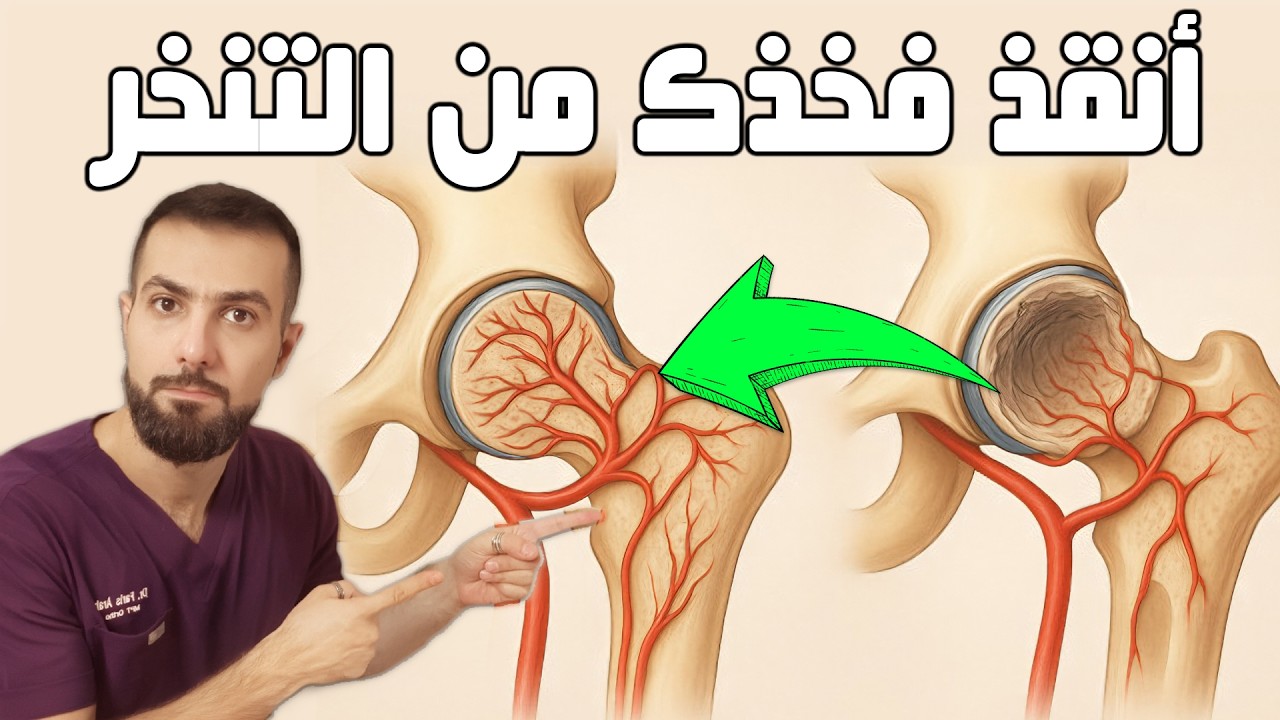 نخر رأس عظمة الفخذ اللاوعائي تمارين تنقذك من العملية | Hip Avascular Osteonecrosis