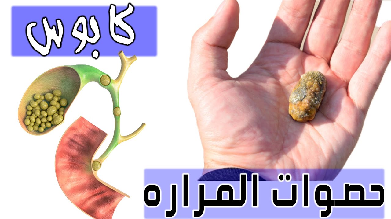 دواء ازاله وتفتيت حصوات المراره. كيف تتكون حصوه المراره؟