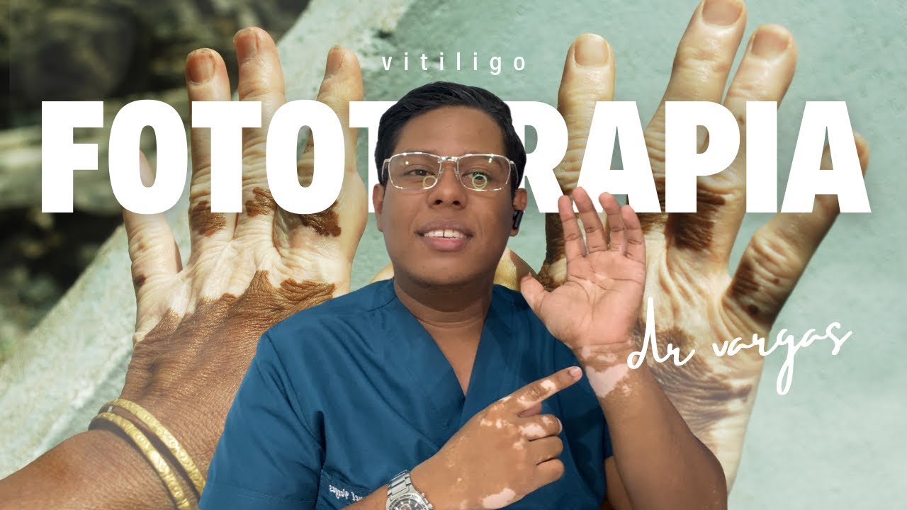FOTOTERAPIA, opci&oacute;n para tratar el Vitiligo: &iexcl;Recupera tu tono de piel uniforme!