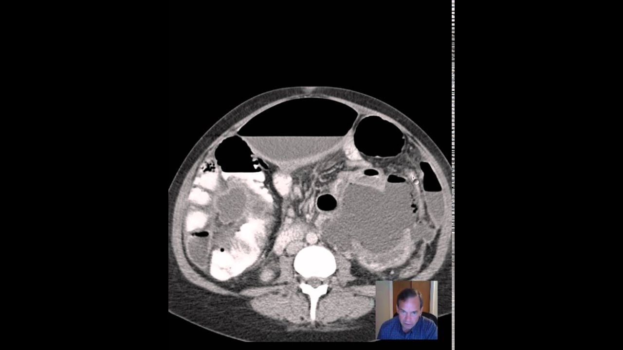 Abscesses following C Section