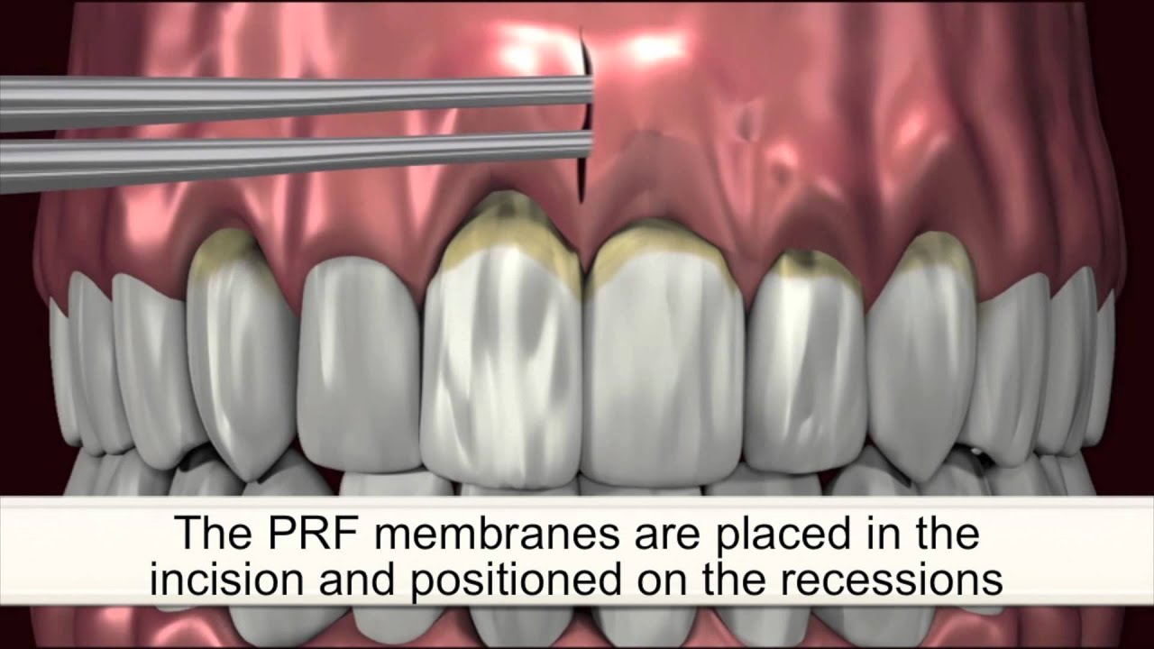 Painless Gum Recession Treatment | (310) 299-8329 | RejuvaGum Lift | Los Angeles Periodontist