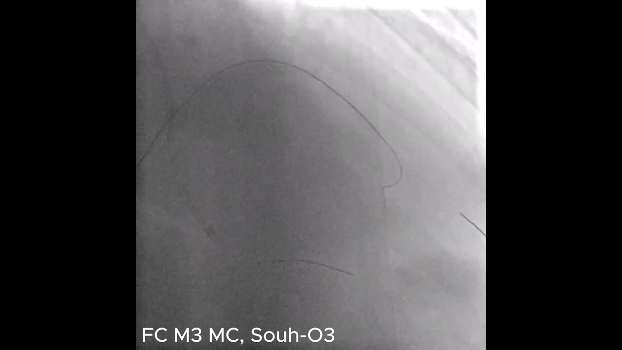 Prof.Dr. Ömer Göktekin & Dr.Haşim Tüner   Complex PCI+CTO+CHIP