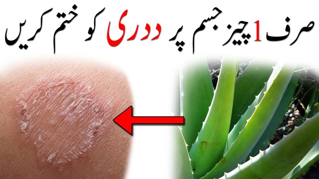 Daad Ka ilaj in Urdu | Treatment of Ringworm in Urdu | داد کا دیسی علاج