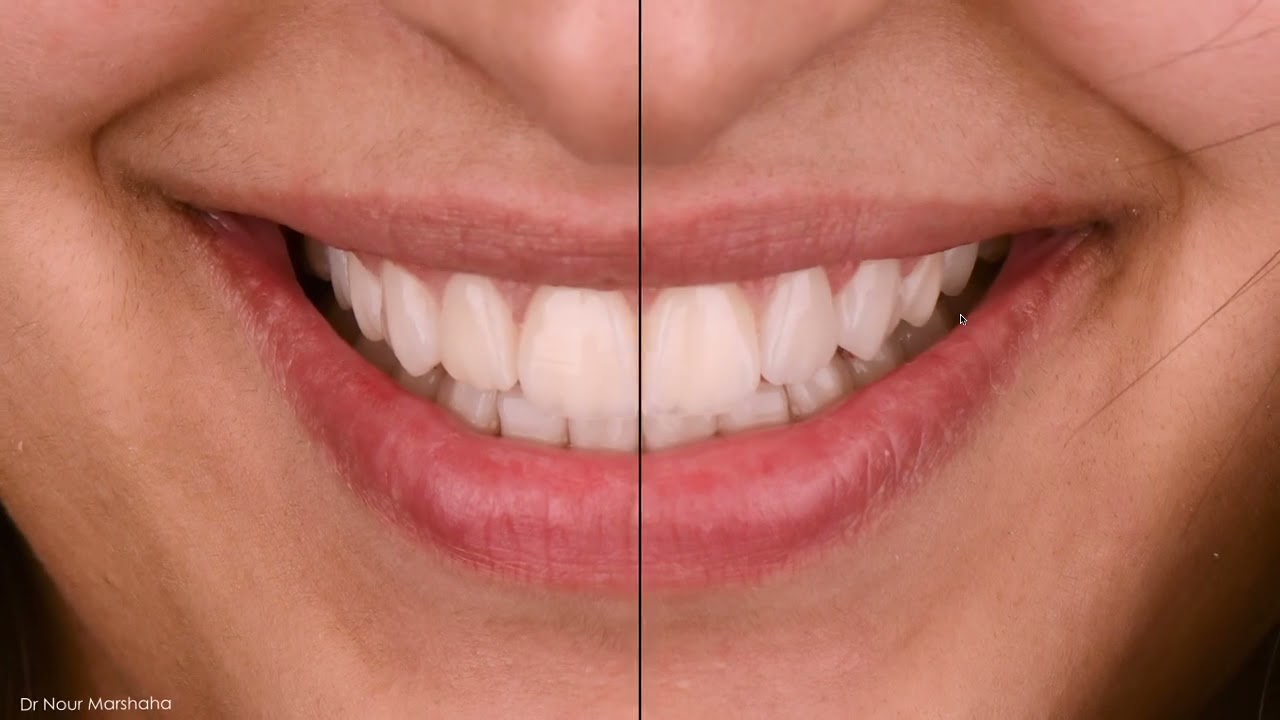 The Concept Of Digital Smile Design And How To Do It. Dr. Nour Marshaha