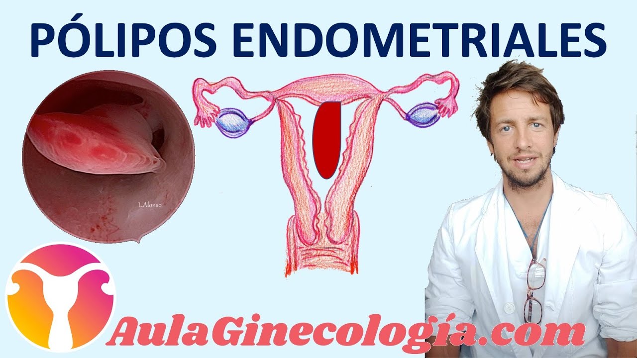 P&Oacute;LIPOS UTERINOS: Causas, riesgo de c&aacute;ncer, diagn&oacute;stico y tratamiento   - Ginecolog&iacute;a y Obstetricia