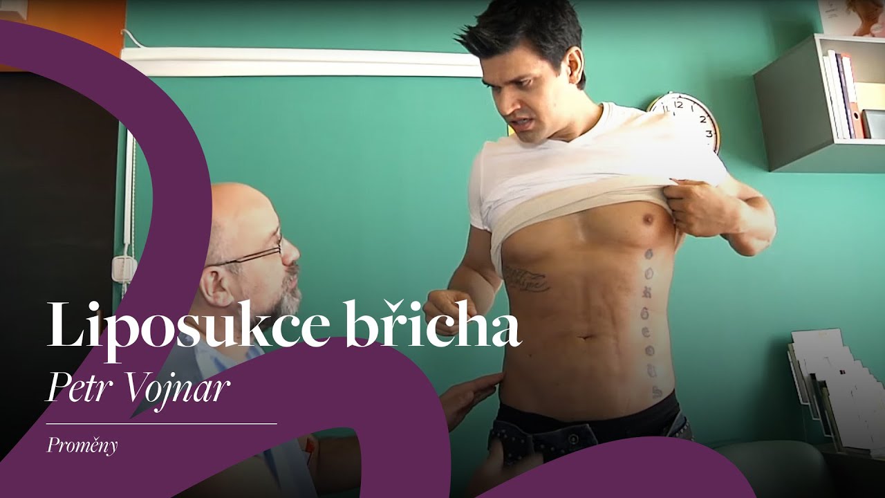 Liposukce břicha | Petr Vojnar | MedicomVIP