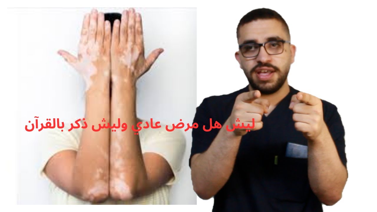 ماهو البهاق وليش ذكر بالقرآن